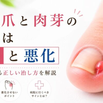 陥入爪と肉芽の痛みは切ると悪化アイキャッチ