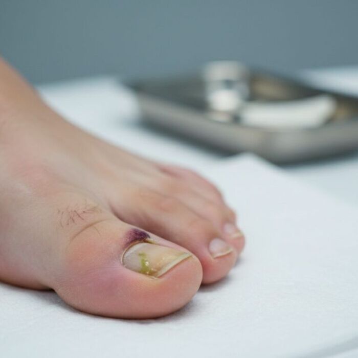 ingrown-toenail-neglect-risks-thumbnail